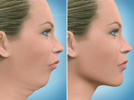 Orthognathic Surgery